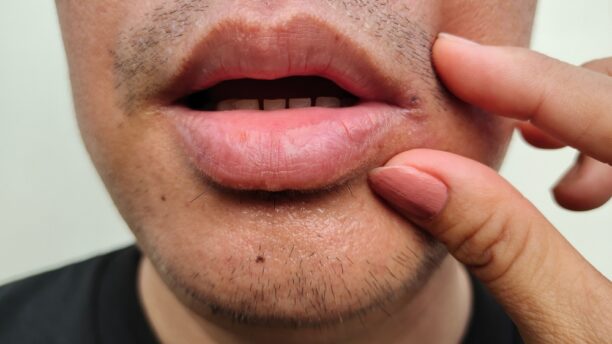 What Causes Canker Sores
