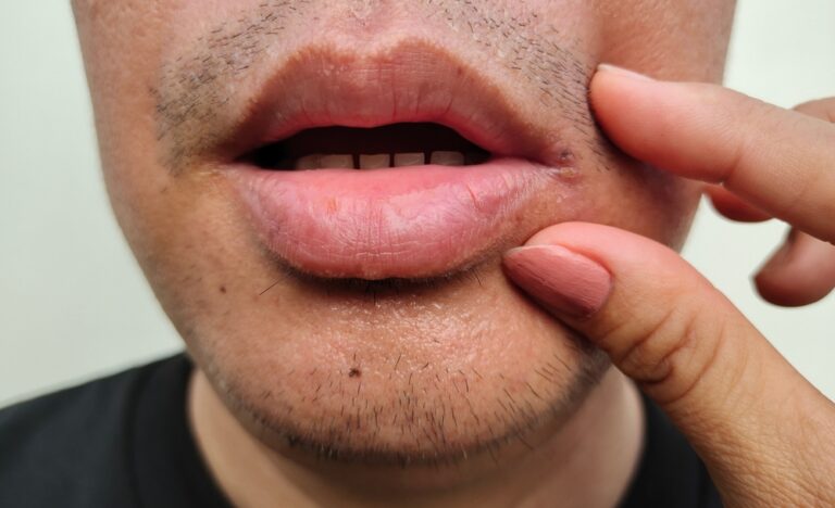 What Causes Canker Sores