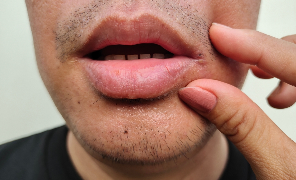 What Causes Canker Sores