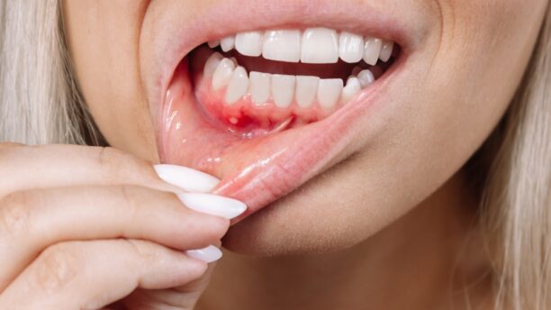 What Your Mouth Ulcers Might Be Trying to Tell You