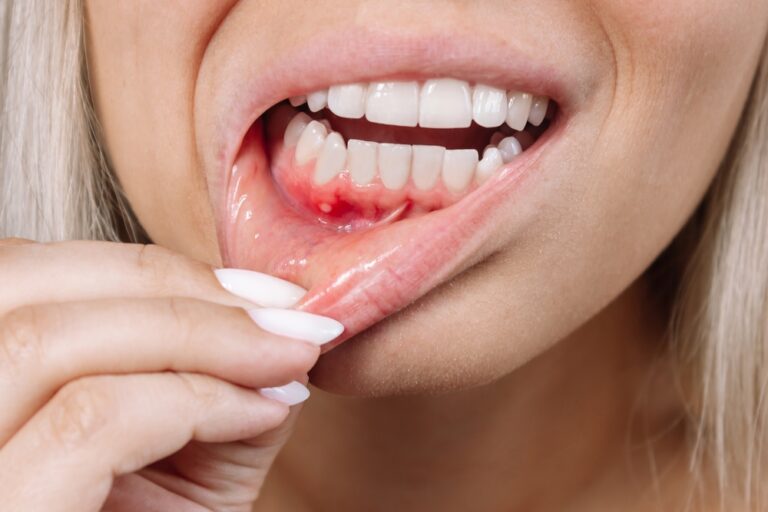 What Your Mouth Ulcers Might Be Trying to Tell You